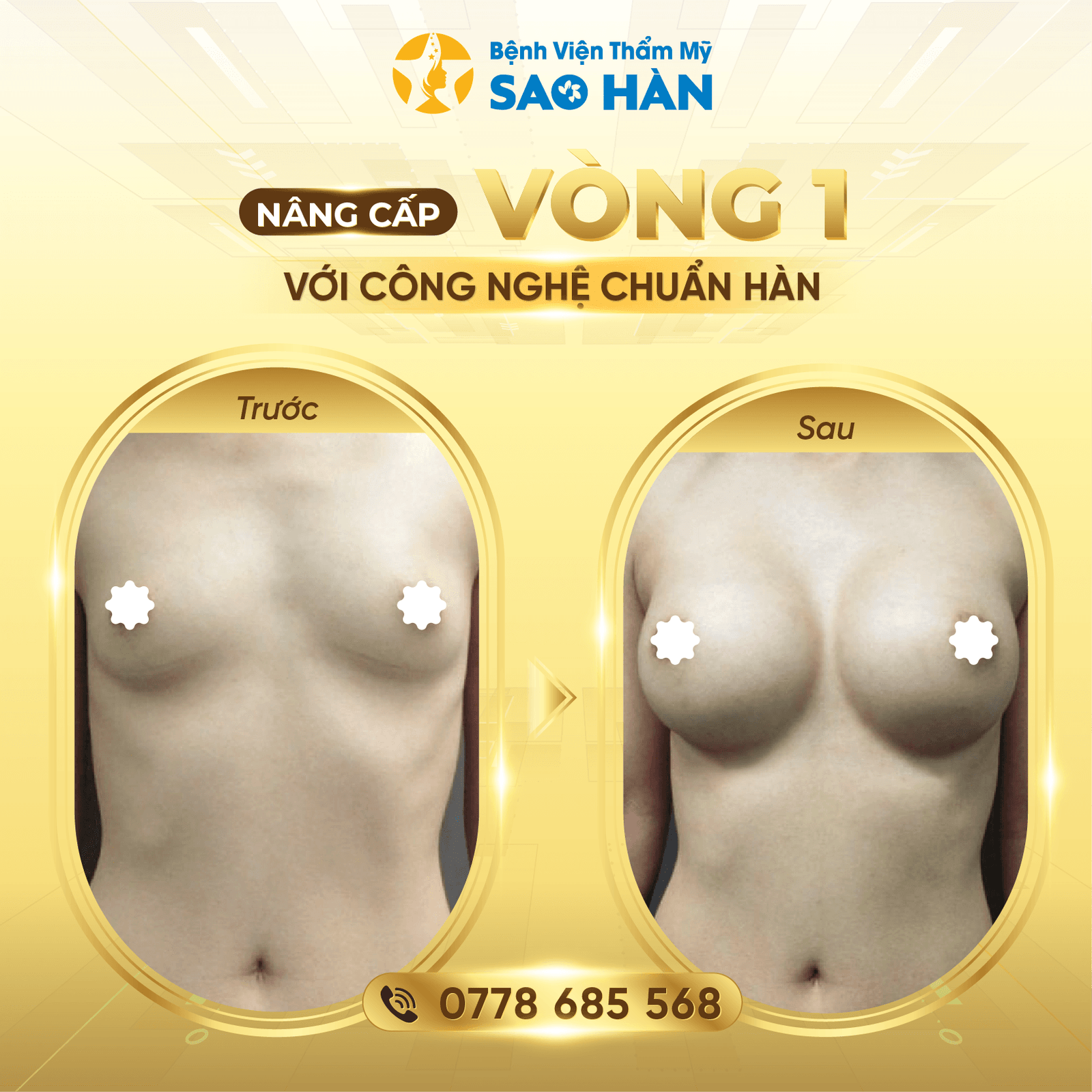 Nâng ngực - Mông-02